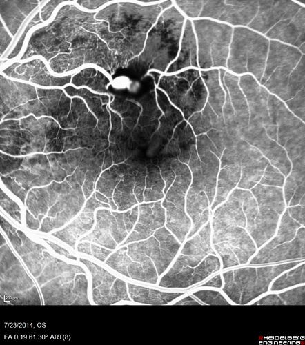 Retinal Arterial  Macroaneurysm treated with Laser
89 year old female with peripapillary CNVM treated with Lucentis. Vision was 20/25 OS 3 weeks ago.  She noticed vision loss OS.  Vision had dropped to 20/60.  She had a fresh MA and was treated with laser.
