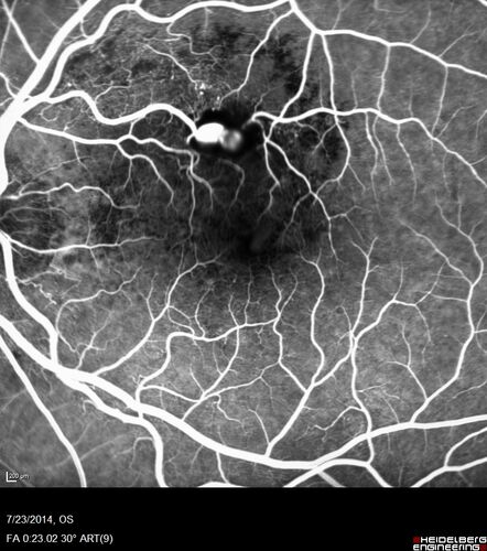 Retinal Arterial  Macroaneurysm treated with Laser
89 year old female with peripapillary CNVM treated with Lucentis. Vision was 20/25 OS 3 weeks ago.  She noticed vision loss OS.  Vision had dropped to 20/60.  She had a fresh MA and was treated with laser.
