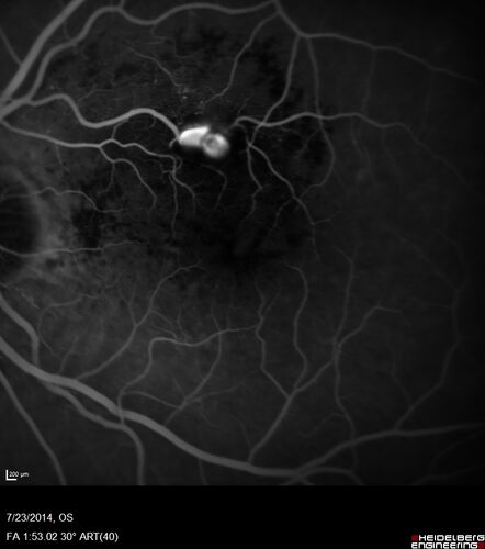Retinal Arterial  Macroaneurysm treated with Laser
89 year old female with peripapillary CNVM treated with Lucentis. Vision was 20/25 OS 3 weeks ago.  She noticed vision loss OS.  Vision had dropped to 20/60.  She had a fresh MA and was treated with laser.
