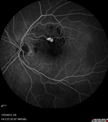 Retinal Arterial  Macroaneurysm treated with Laser
89 year old female with peripapillary CNVM treated with Lucentis. Vision was 20/25 OS 3 weeks ago.  She noticed vision loss OS.  Vision had dropped to 20/60.  She had a fresh MA and was treated with laser.
