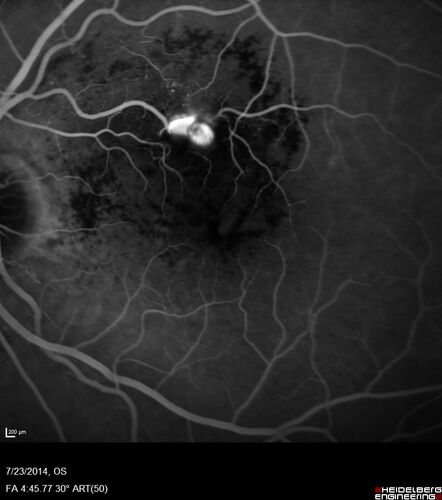 Retinal Arterial  Macroaneurysm treated with Laser
89 year old female with peripapillary CNVM treated with Lucentis. Vision was 20/25 OS 3 weeks ago.  She noticed vision loss OS.  Vision had dropped to 20/60.  She had a fresh MA and was treated with laser.
