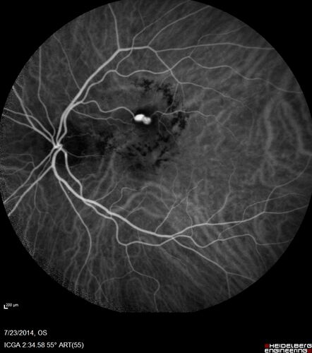 Retinal Arterial  Macroaneurysm treated with Laser
89 year old female with peripapillary CNVM treated with Lucentis. Vision was 20/25 OS 3 weeks ago.  She noticed vision loss OS.  Vision had dropped to 20/60.  She had a fresh MA and was treated with laser.
