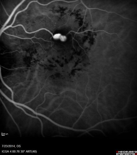 Retinal Arterial  Macroaneurysm treated with Laser
89 year old female with peripapillary CNVM treated with Lucentis. Vision was 20/25 OS 3 weeks ago.  She noticed vision loss OS.  Vision had dropped to 20/60.  She had a fresh MA and was treated with laser.

