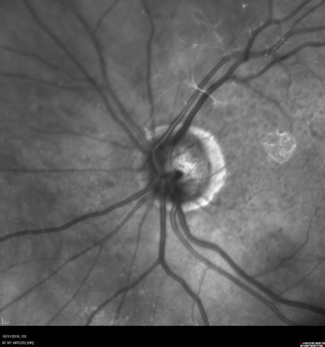 Submacular Hemorrhage - wet AMD
84 year old man with 20/200 from submacular hemorrhage.  Vision improved to 20/32 with only Avastin therapy (no surgical intervention).  The initial FAF is interesting because parts of the blood hyper auto fluoresce.
