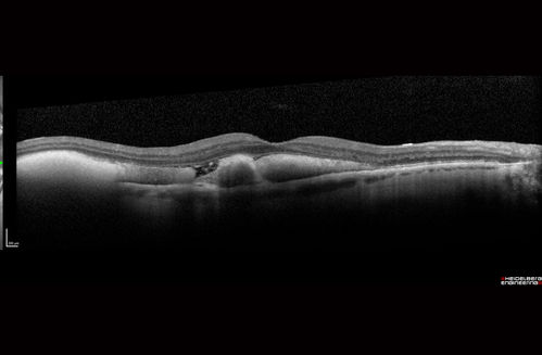 Submacular Hemorrhage - wet AMD
84 year old man with 20/200 from submacular hemorrhage.  Vision improved to 20/32 with only Avastin therapy (no surgical intervention).  The initial FAF is interesting because parts of the blood hyper auto fluoresce.
