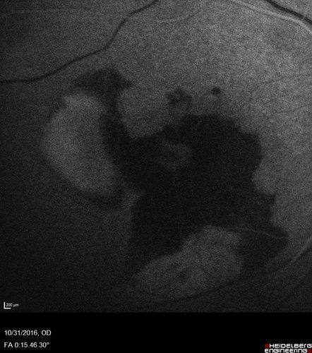 Submacular Hemorrhage - wet AMD
84 year old man with 20/200 from submacular hemorrhage.  Vision improved to 20/32 with only Avastin therapy (no surgical intervention).  The initial FAF is interesting because parts of the blood hyper auto fluoresce.
