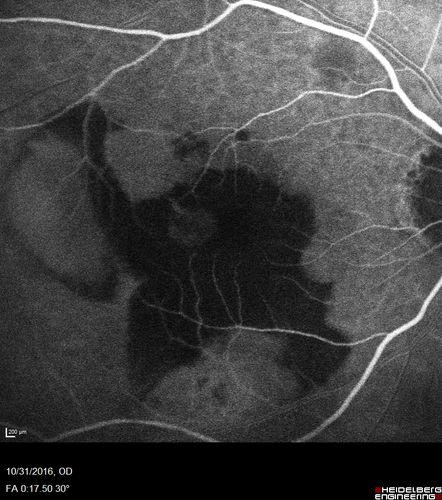 Submacular Hemorrhage - wet AMD
84 year old man with 20/200 from submacular hemorrhage.  Vision improved to 20/32 with only Avastin therapy (no surgical intervention).  The initial FAF is interesting because parts of the blood hyper auto fluoresce.
