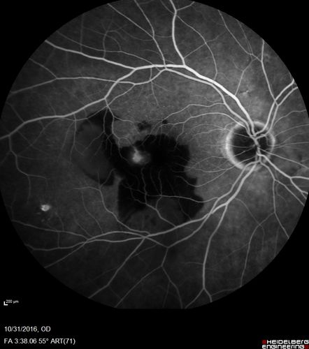 Submacular Hemorrhage - wet AMD
84 year old man with 20/200 from submacular hemorrhage.  Vision improved to 20/32 with only Avastin therapy (no surgical intervention).  The initial FAF is interesting because parts of the blood hyper auto fluoresce.

