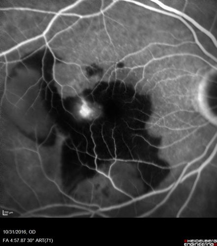 Submacular Hemorrhage - wet AMD
84 year old man with 20/200 from submacular hemorrhage.  Vision improved to 20/32 with only Avastin therapy (no surgical intervention).  The initial FAF is interesting because parts of the blood hyper auto fluoresce.
