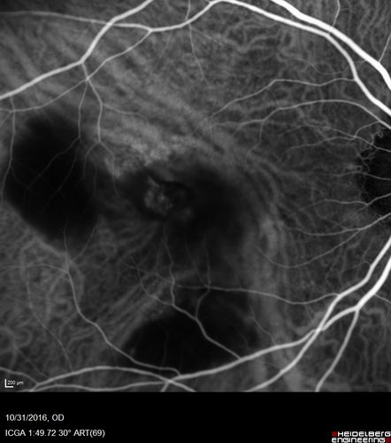 Submacular Hemorrhage - wet AMD
84 year old man with 20/200 from submacular hemorrhage.  Vision improved to 20/32 with only Avastin therapy (no surgical intervention).  The initial FAF is interesting because parts of the blood hyper auto fluoresce.
