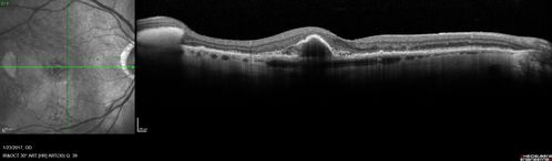 Submacular Hemorrhage - wet AMD
84 year old man with 20/200 from submacular hemorrhage.  Vision improved to 20/32 with only Avastin therapy (no surgical intervention).  The initial FAF is interesting because parts of the blood hyper auto fluoresce.
