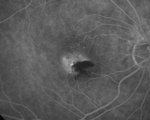 Juxtafoveal Telangiectasis Asymptomatic New Hemorrhage
73-year-old woman has juxtafoveal retinal telangiectasis in both eyes.  The right eye has stage 5 disease.  Her last Avastin treatment in the right eye was in 6 months ago.  The right eye has been the worst of her two eyes for years.

VISUAL ACUITY: Vision OD is 20/200, OS is 20/50.  

Keywords: mactel;juxtafoveal telangiectasis;telangectasia;crystals;hemorrhage
