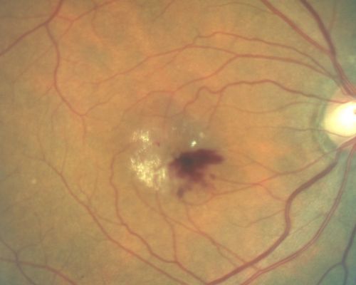 Juxtafoveal Telangiectasis Asymptomatic New Hemorrhage
73-year-old woman has juxtafoveal retinal telangiectasis in both eyes.  The right eye has stage 5 disease.  Her last Avastin treatment in the right eye was in 6 months ago.  The right eye has been the worst of her two eyes for years.

VISUAL ACUITY: Vision OD is 20/200, OS is 20/50.  

Mots-clés: mactel;juxtafoveal telangiectasis;telangectasia;crystals;hemorrhage