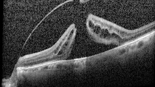 Macular Hole with Limited Retinal Detachment
87 year old female with decreased vision in the left eye for 2 months.  VA 5/200.  Initial three images are pre-op.  Then there is 3 months 6 months and 9 months post-op scans.  VA improved at 1 year to 20/50.  Surgery was done with Brilliant Blue.
