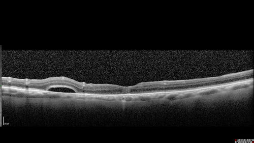 Macular Hole with Limited Retinal Detachment - 3 months post-op
87 year old female with decreased vision in the left eye for 2 months.  VA 5/200.  Initial three images are pre-op.  Then there is 3 months 6 months and 9 months post-op scans.  VA improved at 1 year to 20/50.  Surgery was done with Brilliant Blue.
