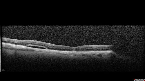 Macular Hole with Limited Retinal Detachment - 9 months post-op
87 year old female with decreased vision in the left eye for 2 months.  VA 5/200.  Initial three images are pre-op.  Then there is 3 months 6 months and 9 months post-op scans.  VA improved at 1 year to 20/50.  Surgery was done with Brilliant Blue.

