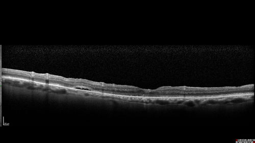Macular Hole with Limited Retinal Detachment - 6 months post-op
87 year old female with decreased vision in the left eye for 2 months.  VA 5/200.  Initial three images are pre-op.  Then there is 3 months 6 months and 9 months post-op scans.  VA improved at 1 year to 20/50.  Surgery was done with Brilliant Blue.
