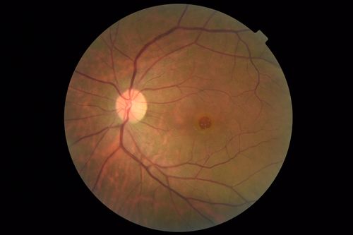 Stage 4 Macular Hole
57 year old female with 20/160 vision and stage 4 macular hole
