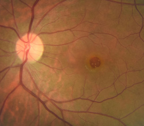 Stage 4 Macular Hole
57 year old female with 20/160 vision and stage 4 macular hole
