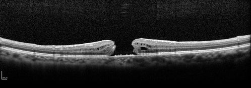Stage 4 Macular Hole
57 year old female with 20/160 vision and stage 4 macular hole
