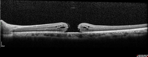 Stage 4 Macular Hole
57 year old female with 20/160 vision and stage 4 macular hole
