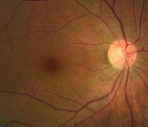 Stage 4 Macular Hole
57 year old female with 20/160 vision and stage 4 macular hole

