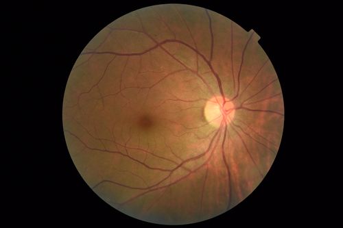 Stage 4 Macular Hole
57 year old female with 20/160 vision and stage 4 macular hole
