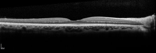 Stage 4 Macular Hole
57 year old female with 20/160 vision and stage 4 macular hole
