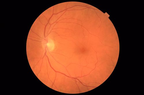 Stage 2-3 Macular Hole - Closed with Vitrectomy and ILM peel with Brilliant blue
68 year old female was 20/100 with macular hole - VA improved to 20/25 post-op.  C3F8 was used
