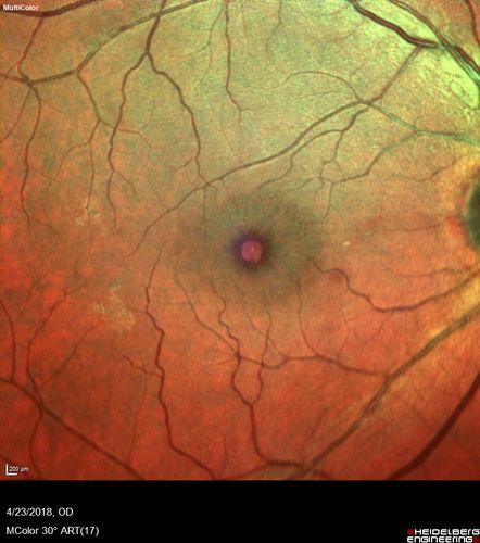 Stage 2-3 Macular Hole - Closed with Vitrectomy and ILM peel with Brilliant blue
68 year old female was 20/100 with macular hole - VA improved to 20/25 post-op.  C3F8 was used
