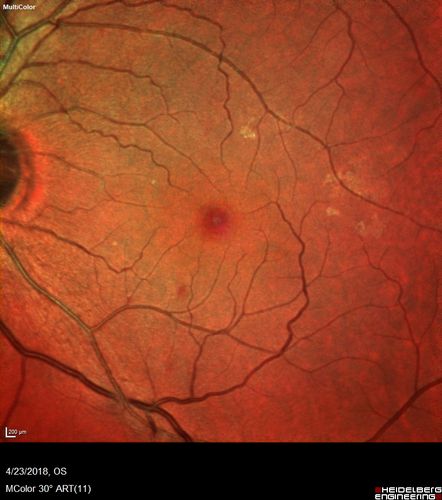 Stage 2-3 Macular Hole - Closed with Vitrectomy and ILM peel with Brilliant blue
68 year old female was 20/100 with macular hole - VA improved to 20/25 post-op.  C3F8 was used
