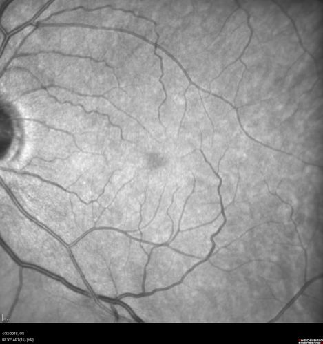 Stage 2-3 Macular Hole - Closed with Vitrectomy and ILM peel with Brilliant blue
68 year old female was 20/100 with macular hole - VA improved to 20/25 post-op.  C3F8 was used
