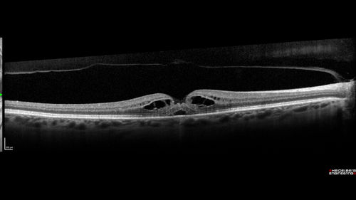 Stage 2-3 Macular Hole - Closed with Vitrectomy and ILM peel with Brilliant blue
68 year old female was 20/100 with macular hole - VA improved to 20/25 post-op.  C3F8 was used

