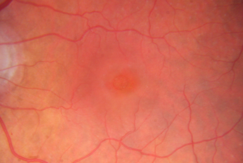 Macular Hole - Asymptomatic - 20/400 Vision
75-year-old woman in a recent exam it was noticed her vision in the left eye had substantially declined.  She is not clear as to when that exactly happened.  She had not noticed a vision change in the left eye.  VISUAL ACUITY:  OD 20/30,  OS 20/400.
