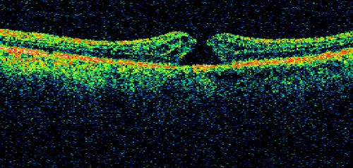 Macular Hole - Asymptomatic - 20/400 Vision
75-year-old woman in a recent exam it was noticed her vision in the left eye had substantially declined.  She is not clear as to when that exactly happened.  She had not noticed a vision change in the left eye.  VISUAL ACUITY:  OD 20/30,  OS 20/400.
