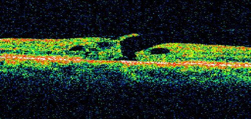 Stage 2 20/100 Idiopathic Macular Hole
62-year-old woman has a macular hole in the left eye.  Her vision is worse than when she was here 1 month ago with a 100 micron hole

VISUAL ACUITY:  OS 20/100.
