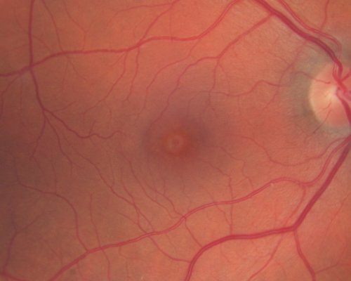 Stage 2 Macular Hole with 20/70 Vision
57-year-old woman blurred central vision in the right eye for about two to three weeks.   OD 20/70
