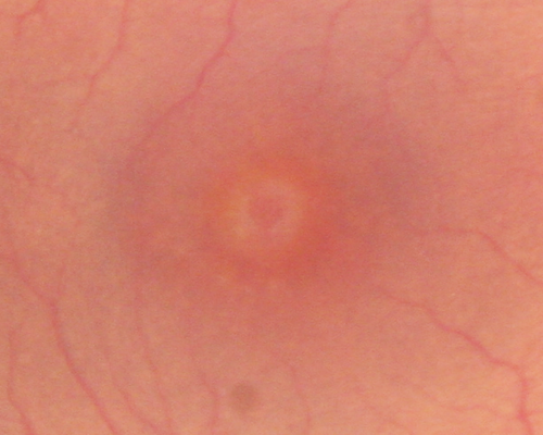 Stage 2 Macular Hole with 20/70 Vision
57-year-old woman blurred central vision in the right eye for about two to three weeks.   OD 20/70

