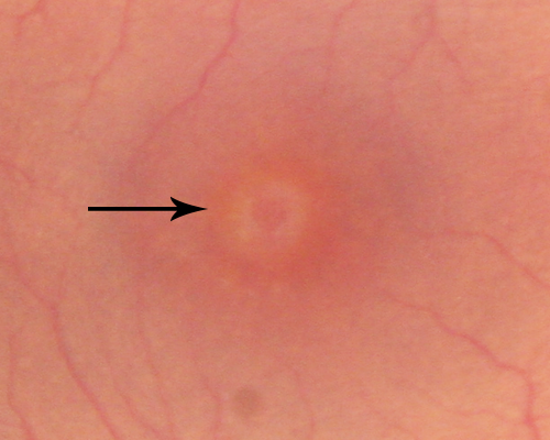 Stage 2 Macular Hole with 20/70 Vision
57-year-old woman blurred central vision in the right eye for about two to three weeks.   OD 20/70
