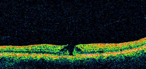 Stage 2 Macular Hole with 20/70 Vision
57-year-old woman blurred central vision in the right eye for about two to three weeks.   OD 20/70

