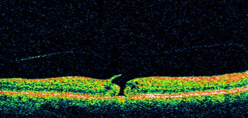 Stage 2 Macular Hole with 20/70 Vision
57-year-old woman blurred central vision in the right eye for about two to three weeks.   OD 20/70
