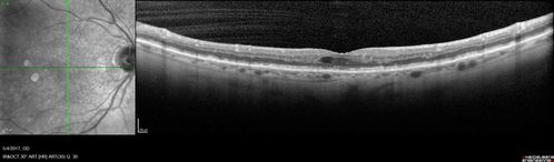 Macular Laser Scars Left Eye - 5/200 Vision
83 year old woman who had extensive macular laser in the left eye about 15 years ago for DME.  Vision is now 20/50 right eye and 3/200 left eye
