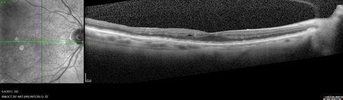 Macular Laser Scars Left Eye - 5/200 Vision
83 year old woman who had extensive macular laser in the left eye about 15 years ago for DME.  Vision is now 20/50 right eye and 3/200 left eye
