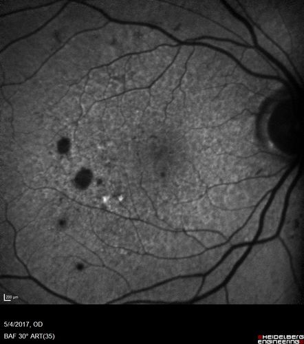 Macular Laser Scars Left Eye - 5/200 Vision
83 year old woman who had extensive macular laser in the left eye about 15 years ago for DME.  Vision is now 20/50 right eye and 3/200 left eye
