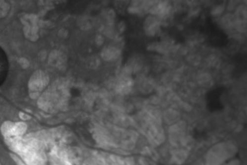 Macular Laser Scars - Patient had Central Retinal Vein Occlusion in her only eye - Infrared
80-year-old woman left eye had a vascular occlusion, probably about five years ago, subsequent to that she had macular laser. She said since then the vision has been poor. OS 20/160.

