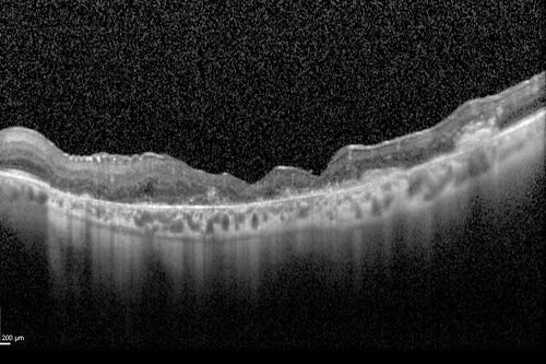 Macular Laser Scars - Patient had Central Retinal Vein Occlusion in her only eye
80-year-old woman left eye had a vascular occlusion, probably about five years ago, subsequent to that she had macular laser. She said since then the vision has been poor. OS 20/160.
