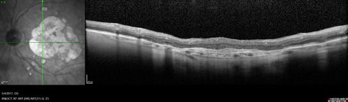 Macular Laser Scars Left Eye - 5/200 Vision
83 year old woman who had extensive macular laser in the left eye about 15 years ago for DME.  Vision is now 20/50 right eye and 3/200 left eye
