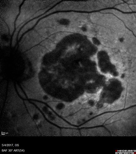 Macular Laser Scars Left Eye - 5/200 Vision
83 year old woman who had extensive macular laser in the left eye about 15 years ago for DME.  Vision is now 20/50 right eye and 3/200 left eye
