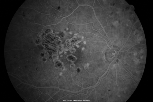 Diabetic Retinopathy - Foveal Laser Scar Right Eye
74-year-old woman has diabetic retinopathy in both eyes.  She has had focal laser in her right eye done elsewhere in the mid 90â€™s and unfortunately the laser was fairly close to the center and as time progressed she developed foveal atrophy around the scars.  She has noticed her vision declining since she was here last a year ago.  She does take Travatan in both eyes at night for glaucoma. 

VISUAL ACUITY:  OD 20/200,  OS 20/40. 
