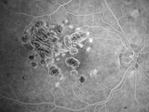 Diabetic Retinopathy - Foveal Laser Scar Right Eye
74-year-old woman has diabetic retinopathy in both eyes.  She has had focal laser in her right eye done elsewhere in the mid 90â€™s and unfortunately the laser was fairly close to the center and as time progressed she developed foveal atrophy around the scars.  She has noticed her vision declining since she was here last a year ago.  She does take Travatan in both eyes at night for glaucoma. 

VISUAL ACUITY:  OD 20/200,  OS 20/40. 
